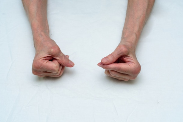 artrita reumatoidă simptomele mâinii