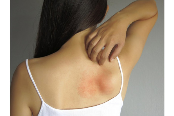 Rinita Alergica (Febra Fanului): Cauze - Simptome - Tratament