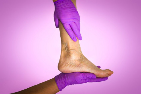 varicoza i tratare a picioarelor eczeme