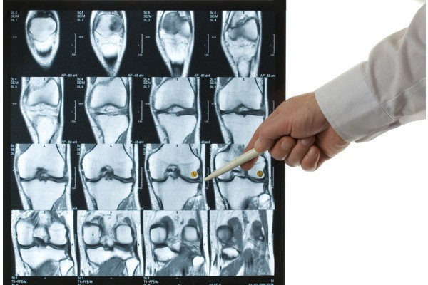 semne radiografice ale artrozei genunchiului)