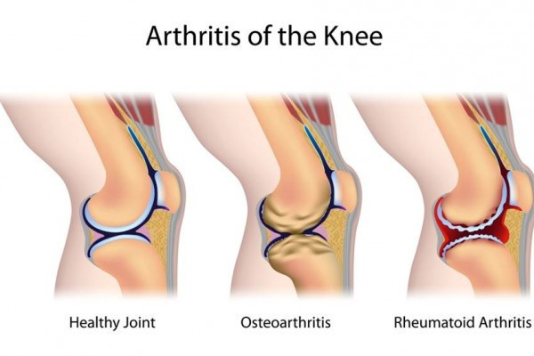 umflarea articulațiilor genunchiului cu artroză)
