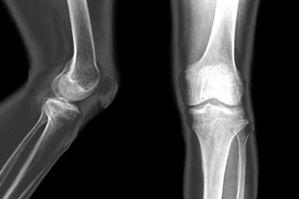 cod artroza genunchiului