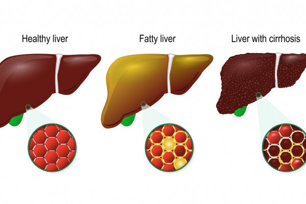 Ce este cancerul hepatic și cum se poate trata