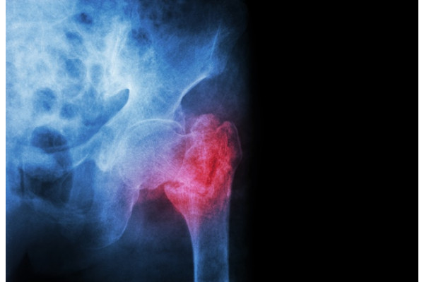 tratamentul fracturii ligamentului de șold vitamina e dureri articulare