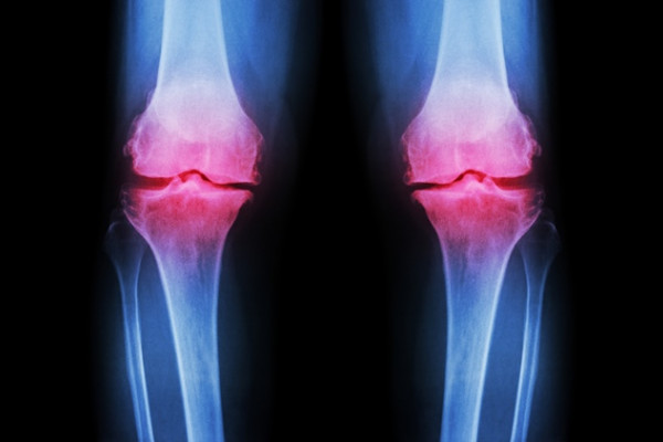 artrita bilaterală a genunchiului dureri la nivelul gâtului la spate