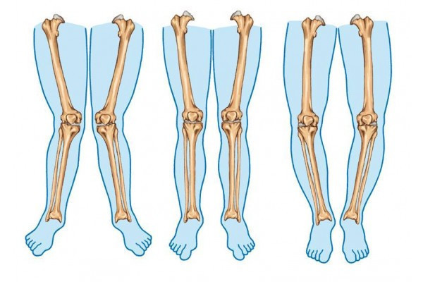 gonartroza care deformează artroza genunchiului