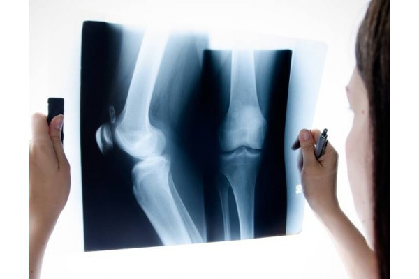artroza genunchilor și modul de tratare)