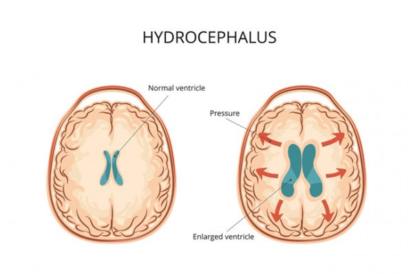 hidrocefalia afectează vederea proteze vizuale