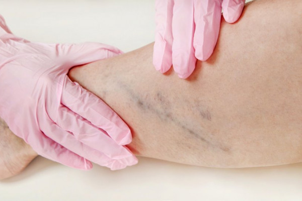 Tratamentul popular față de picioarele varicoase, Latest News