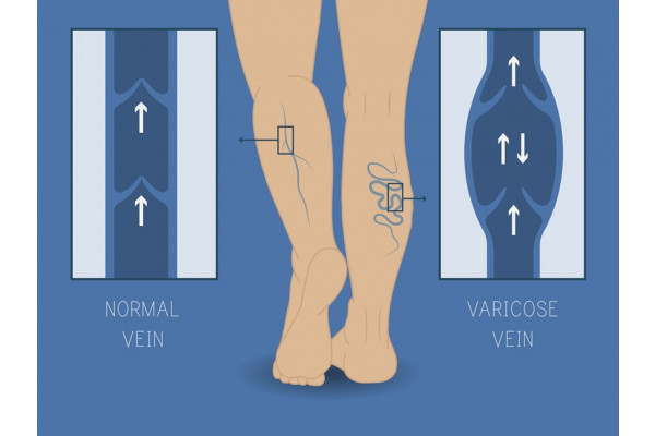 exerciii de prevenire a piciorului varico