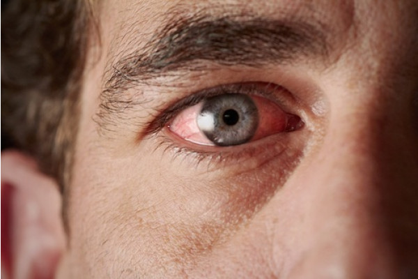 boală oculară uveită