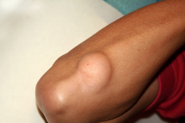 Lipoliza injectabilă 💉 Elimină grăsimea corporală localizată