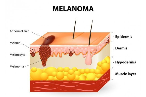 Recenzii pentru tratamentul melanomului de ochi