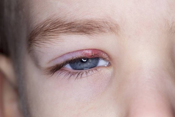 cum se vindecă miopia ușoară exerciții pentru ochi cu miopie