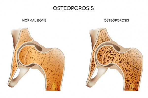 simptomele și tratamentul osteopeniei șoldului