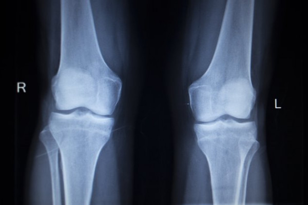 osteoporoza genunchiului