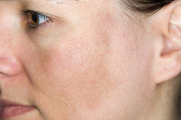 cancer de piele pe obraz