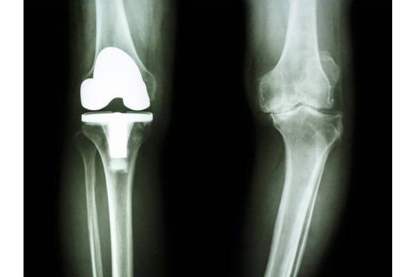 Ultraton amp-2int tratament articular, Am osteochondroza genunchiului
