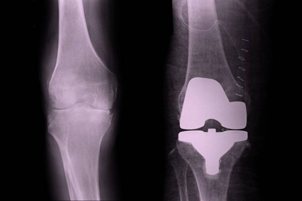 refacerea genunchiului după artrită