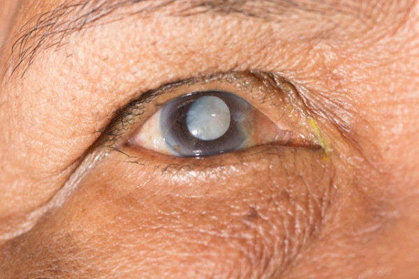 afectiuni ale ochiului la adulti miopie zinc