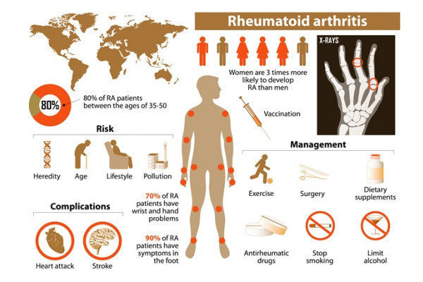 articulațiile artritei reumatoide)