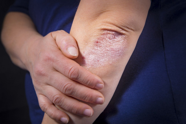 Bolile de piele precum psoriazisul pot fi declansate de catre stres – BIODEV MEDICAL CENTER IAŞI