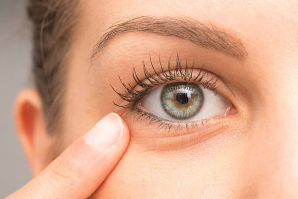 Remedii naturale pentru cearcane si pungile de sub ochi