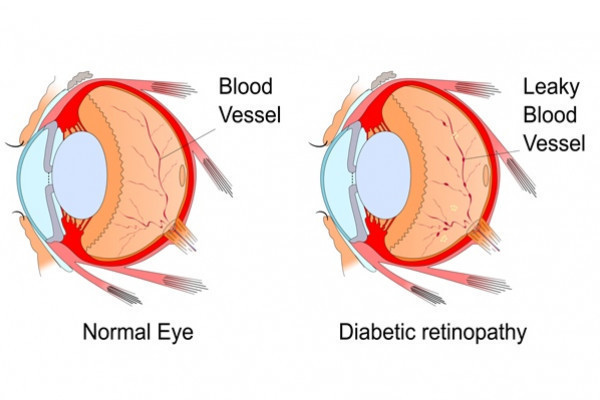 operatie retinopatie diabetica pret