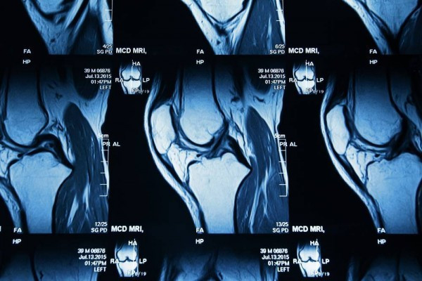 Explorarea imagistica prin rezonanta magnetica in afectiunile genunchiului