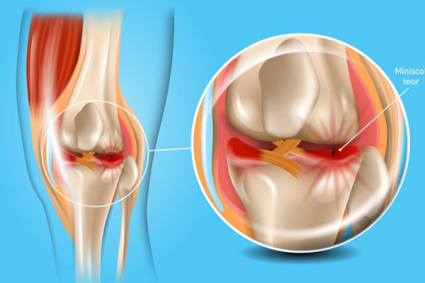 deteriorarea meniscului medial al tratamentului articulației genunchiului stâng