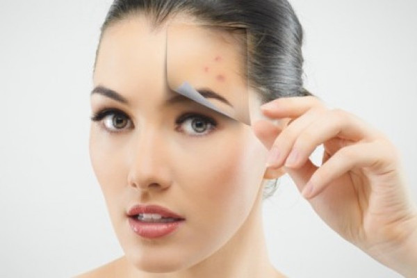 Cum scapi de cicatricile lasate de acnee - Clinica Novia Estetica