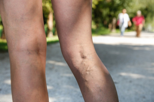simptomele picioarelor varicoase interne ce este consecinele varicoase
