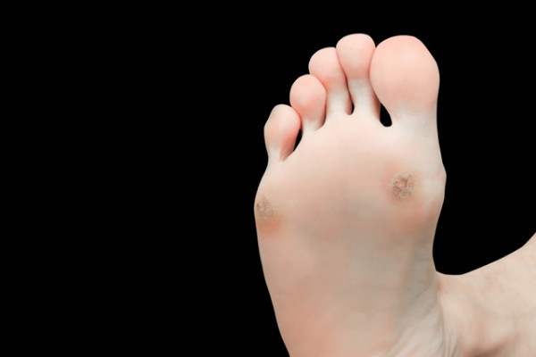 osteoartroza articulațiilor degetelor de la picioare