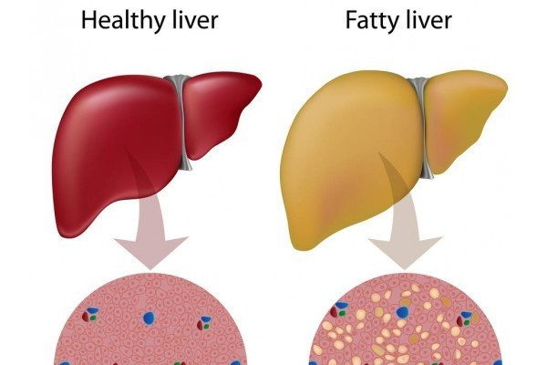 Regimul alimentar in steatoza hepatica