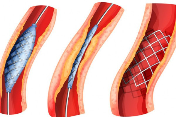 arteriopatie obliterantă cod