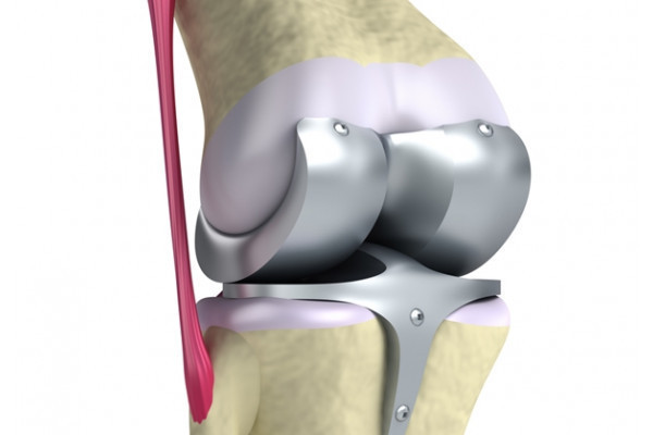 tratamentul chirurgical al artrozei genunchiului