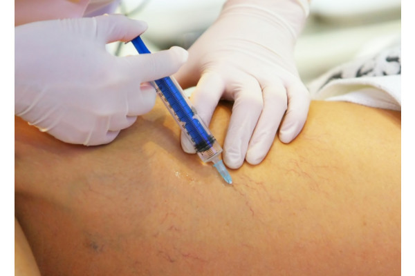 terapie color varicoza varicose pelvis la femeile gravide