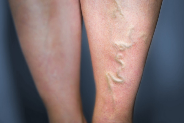 cauze tromboflebită picioarele dureroase în spatele genunchilor varicoza