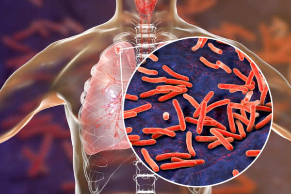 Tuberculoza: cauze, simptome, tratament