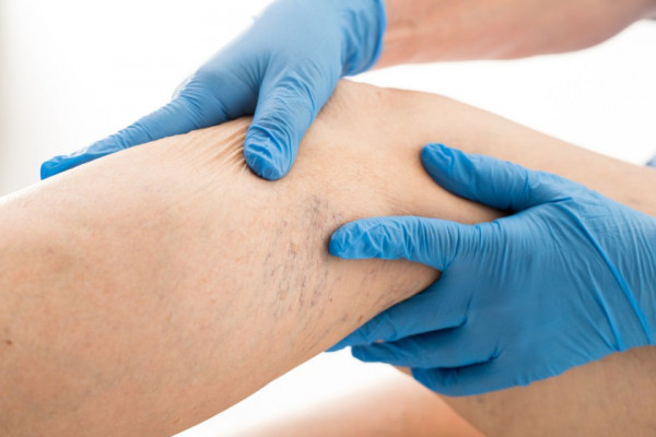 Varicele - Cauze, Simptome, Tratament | Ayurmed Cauzele picioarelor varicoase cauzeaza femeile