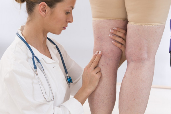 Tratamentul venelor varicoase ale venei pe picioarele medicului