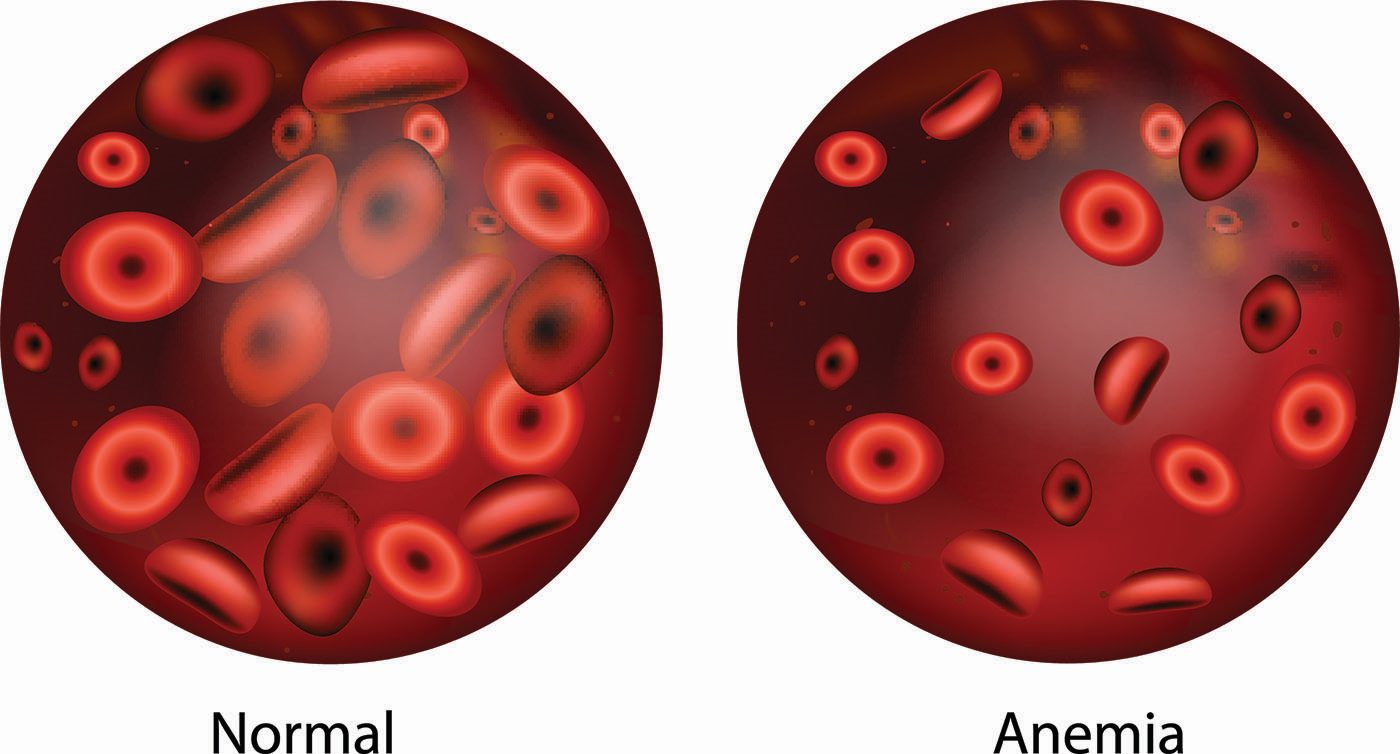 pierderea în greutate simptomele anemiei