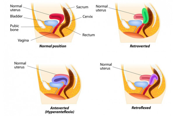 Uterul Retrovers Semnifica Ie Diagnostic I Tratament