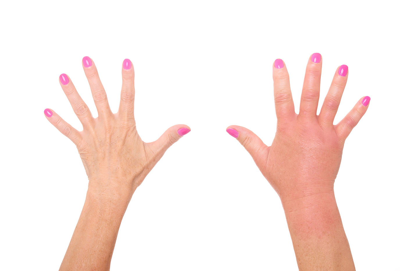 degete umflate la maini puffer în tratamentul artrozei