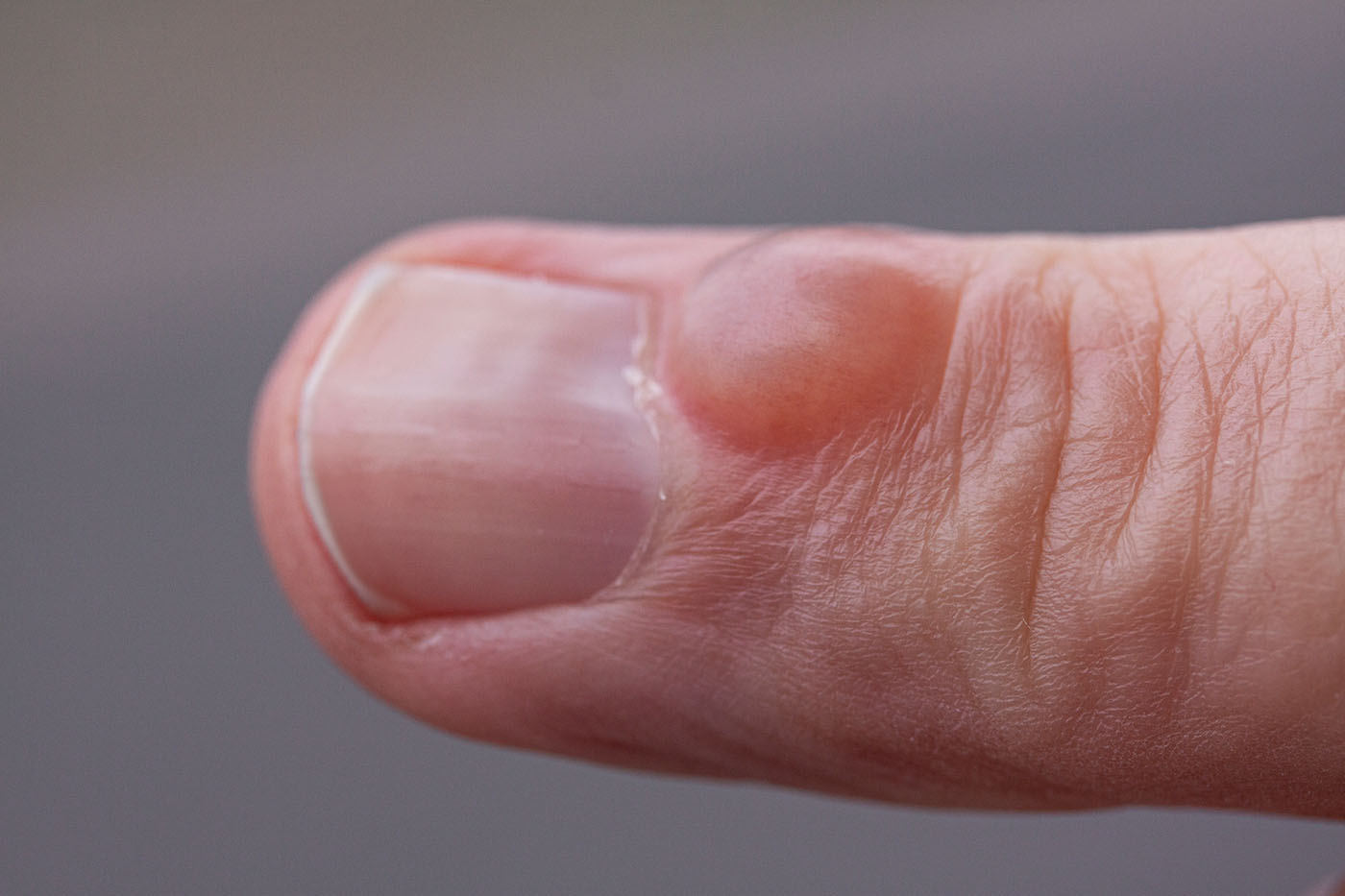 inflamația articulației degetului mare de lângă unghie