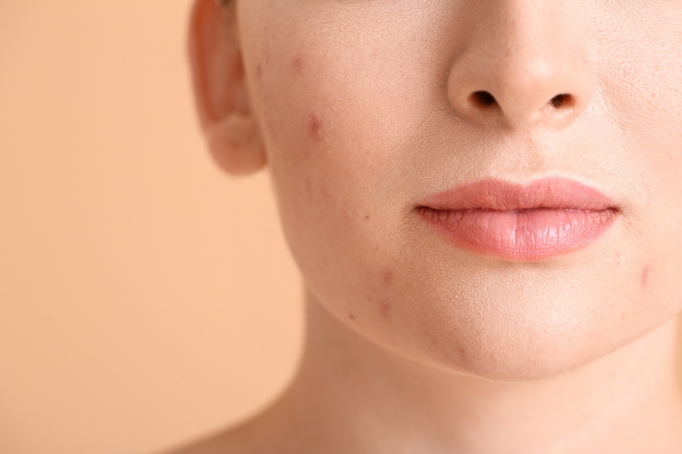 cum să netezi pielea după acnee