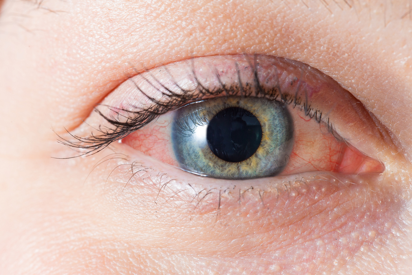 vedere după inflamația ochilor
