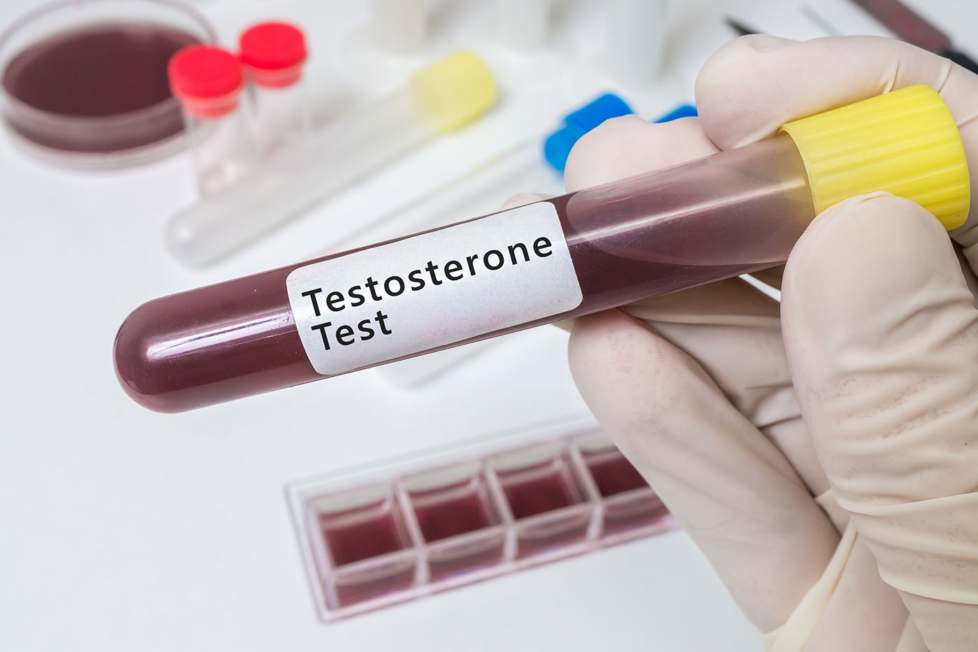 Terapia cu testosteron scade rata infarctului pentru bărbații cu niveluri scăzute ale acestui hormon (studiu)