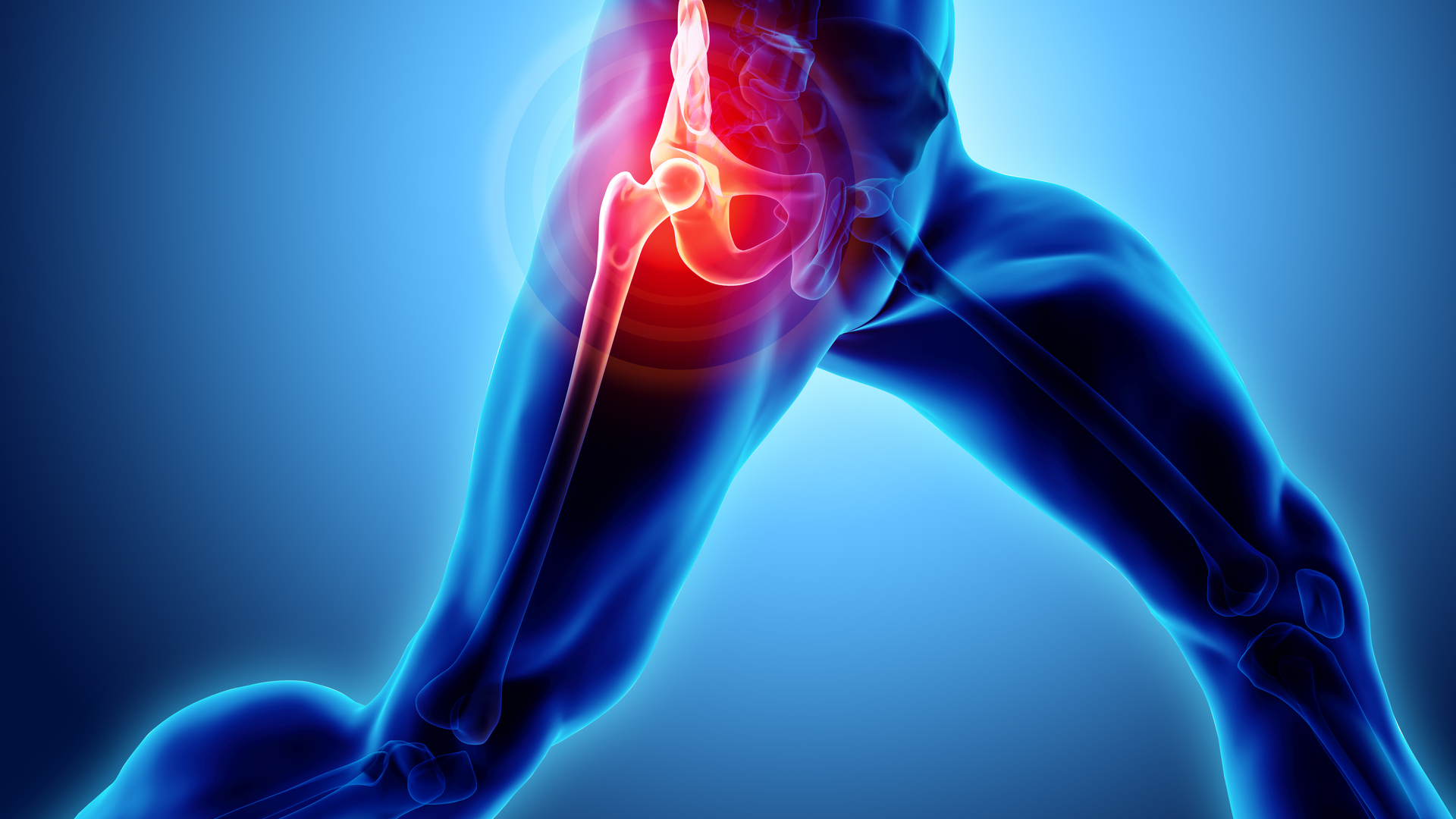 DURERE de ȘOLD: cauze și soluții - Servus Expert, Medicamente pentru durerea articulației șoldului