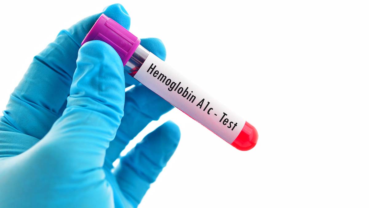 Hemoglobina glicata (Hb A1c ) - Hemoglobina glicozilata